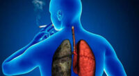 Actualmente existen en el mundo más de 300 millones de personas con dificultad para respirar, expectoración crónica y tos, síntomas provocados por la Enfermedad Pulmonar Obstructiva Crónica (EPOC), padecimiento evitable […]