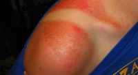 Como la exposición elevada a radiación UV-B puede provocar cáncer de piel, el Programa de las Naciones Unidas para el Medio Ambiente (UNEP, por sus siglas en inglés) se dio […]